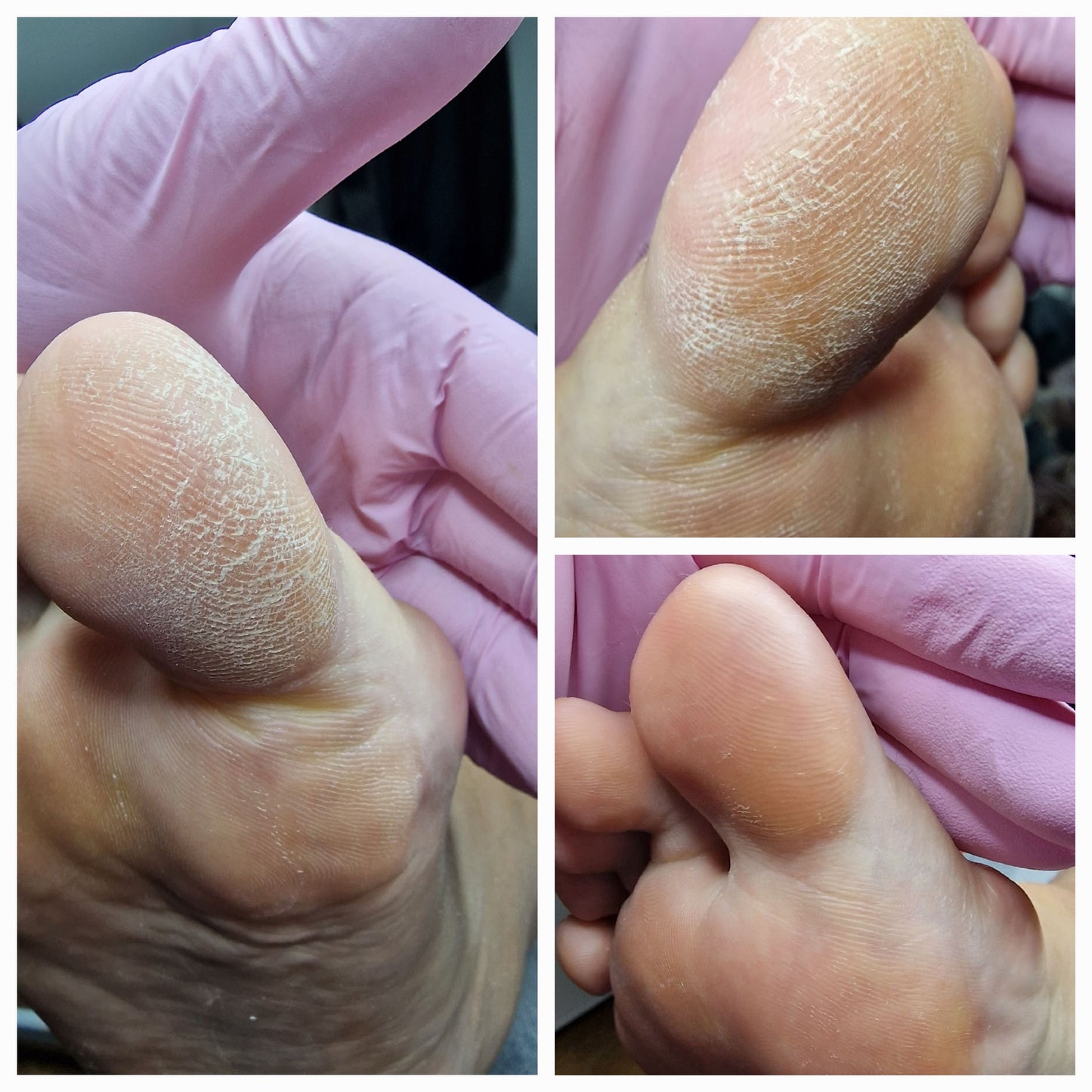 Advanced pedicure course - skin and nail pathologies