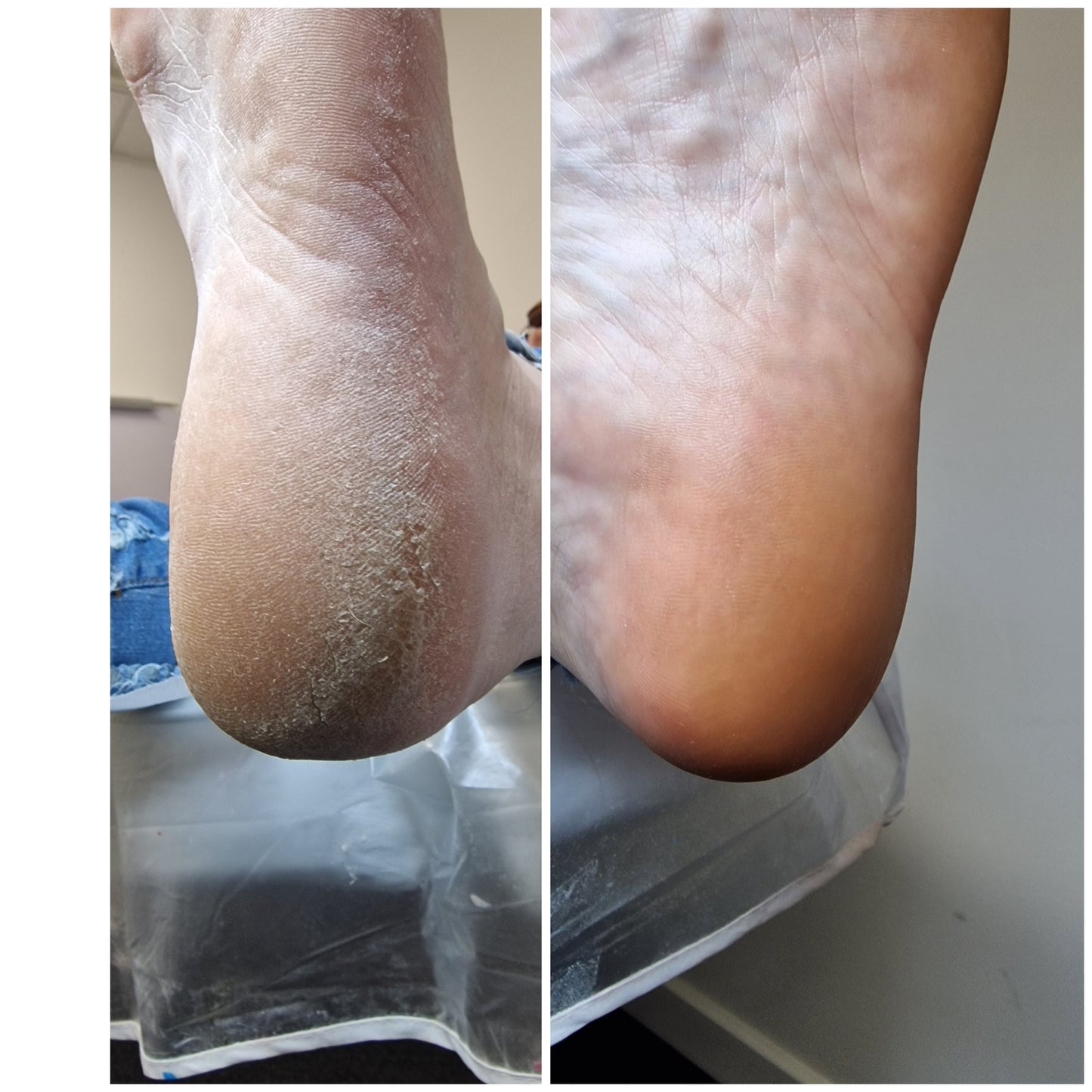 Advanced pedicure course - skin and nail pathologies