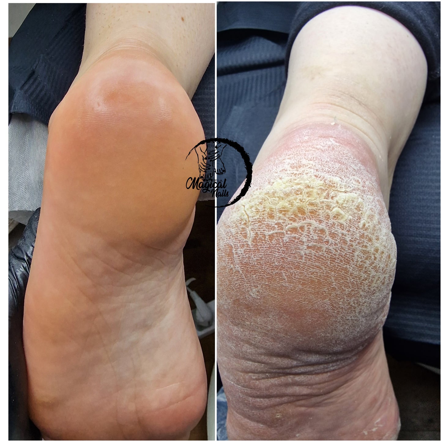 Advanced pedicure course - skin and nail pathologies